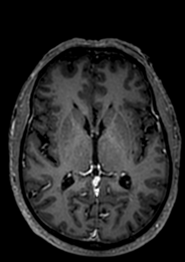 Accessory middle cerebral artery (Radiopaedia 73114-83828 Axial T1 C+ 27).jpg