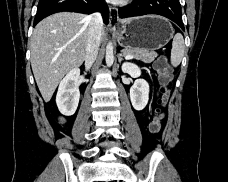 Accessory right inferior hepatic vein (Radiopaedia 75207-86305 Coronal C+ portal venous phase 39).jpg