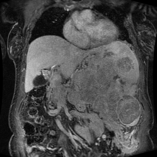 Acinar cell carcinoma of the pancreas (Radiopaedia 75442-86668 Coronal T1 C+ fat sat 122).jpg