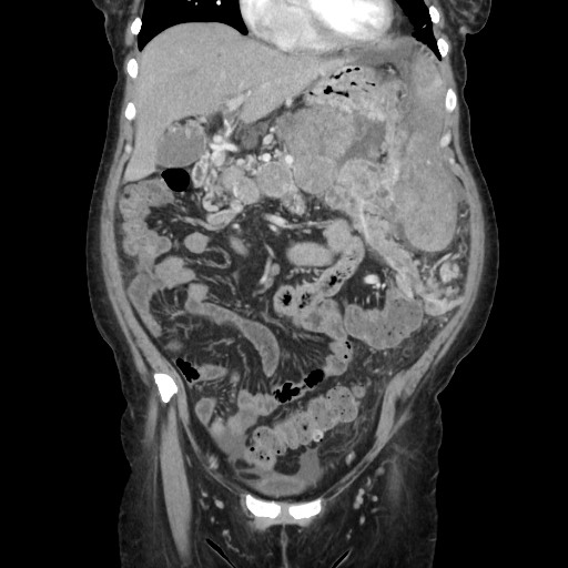 Acinar cell carcinoma of the pancreas (Radiopaedia 75442-86669 Coronal C+ portal venous phase 43).jpg