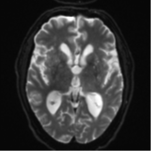 Acoustic schwannoma (Radiopaedia 55729-62281 E 13).png