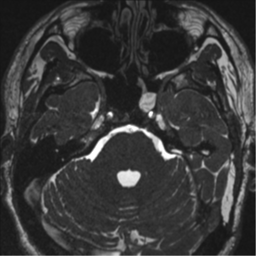 Acoustic schwannoma (translabyrinthine resection) (Radiopaedia 43570-46972 Axial CISS 36).png