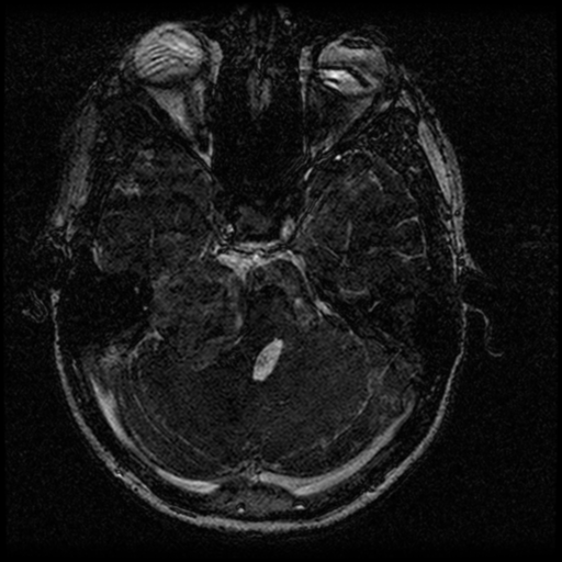 Acoustic schwannoma - eroding petrous apex (Radiopaedia 39674-42004 Axial T2 54).png