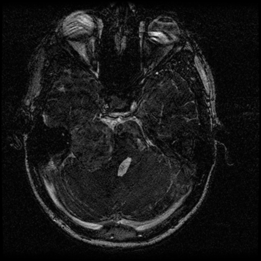 Acoustic schwannoma - eroding petrous apex (Radiopaedia 39674-42004 Axial T2 55).png