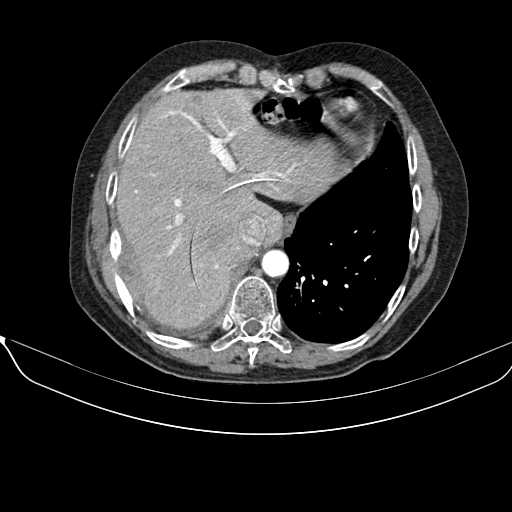 File:Acquired adrenal hyperplasia - due to thymic carcinoid tumor (Radiopaedia 21269-21184 C+ arterial phase 1).jpg