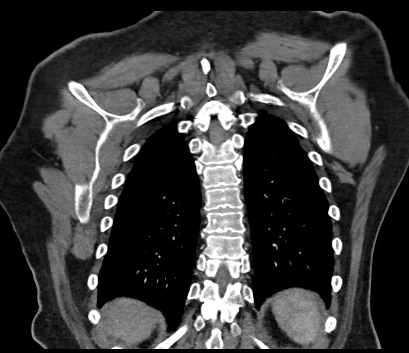File:Acromioclavicular joint cyst (Radiopaedia 58455-65610 Coronal 72).jpg