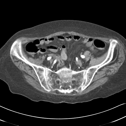 File:Active bleeding from duodenal ulcer with embolization (Radiopaedia 34216-35481 Axial C+ arterial phase 48).png