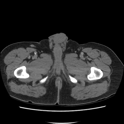 File:Active colonic bleed on CT (Radiopaedia 49765-55025 Axial C+ delayed 92).jpg