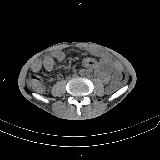 File:Active crohn disease (Radiopaedia 87133-103397 Axial non-contrast 62).jpg