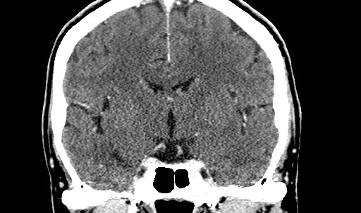 File:Active neurocysticercosis before and after therapy (Radiopaedia 71710-82099 Coronal 11).jpg