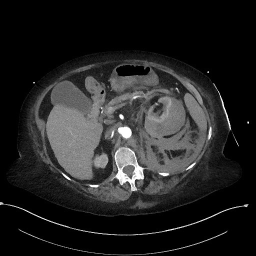 File:Active renal extravasation with large subcapsular and retroperitoneal hemorrhage (Radiopaedia 60975-68796 Axial C+ arterial phase 68).jpg