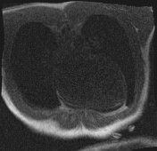 Active right ventricular cardiac sarcoidosis (Radiopaedia 55596-62100 Axial Dynamic perfusion scan MOCO 6).jpg