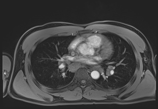 Active right ventricular cardiac sarcoidosis (Radiopaedia 55596-62100 Axial Post contrast Dixon 34).jpg