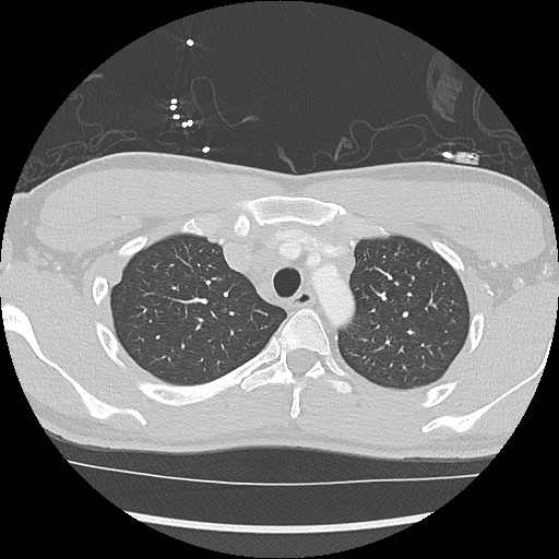 File:Active right ventricular cardiac sarcoidosis (Radiopaedia 55596-62101 Axial lung window 5).jpg