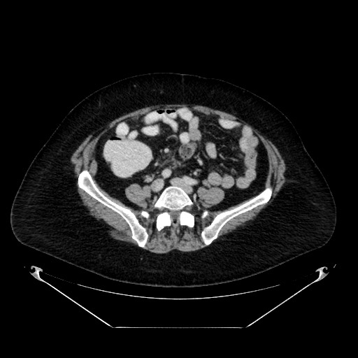 Acute appendicitis, heterotaxy syndrome (Radiopaedia 66884-76202 Axial C+ portal venous phase 86).jpg