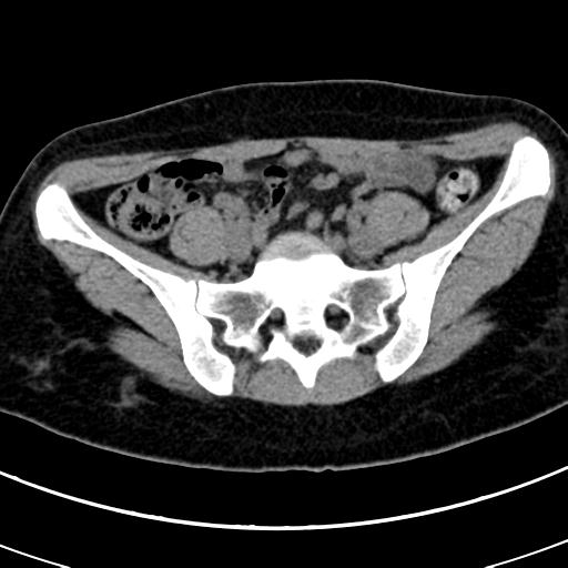 Acute appendicitis (Radiopaedia 30261-30888 Axial non-contrast 71).jpg