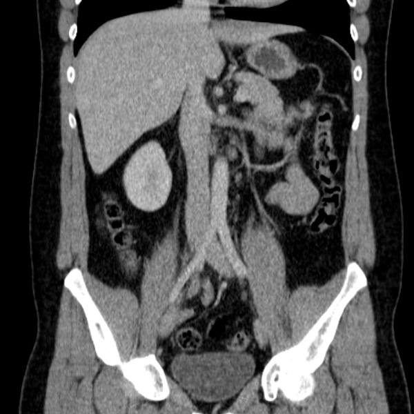 File:Acute appendicitis (Radiopaedia 38255-40270 Coronal C+ portal venous phase 44).jpg