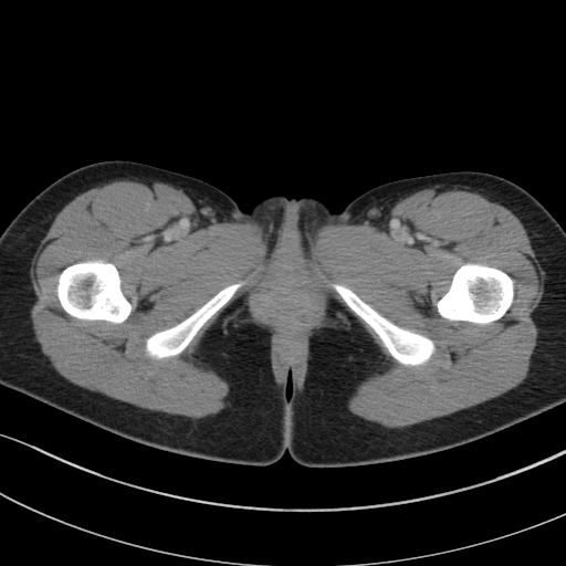 Acute appendicitis (Radiopaedia 62608-70901 Axial C+ portal venous phase 75).jpg