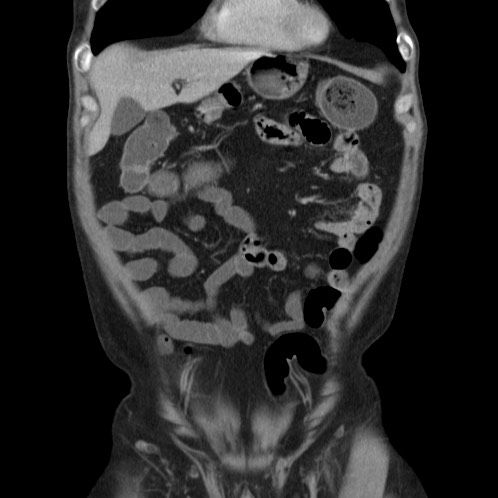 Acute appendicitis (Radiopaedia 66513-75790 Coronal C+ portal venous phase 11).jpg