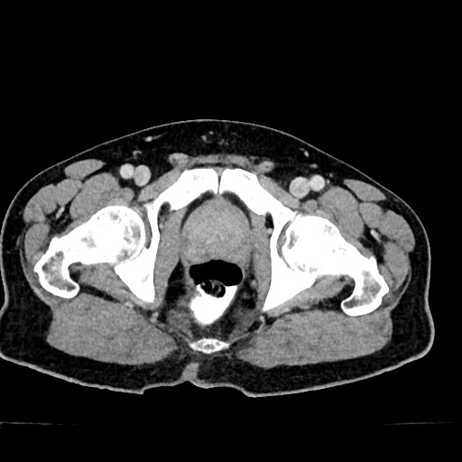 Acute appendicitis (Radiopaedia 77016-88960 Axial C+ portal venous phase 140).jpg
