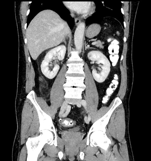 Acute appendicitis (Radiopaedia 77016-88960 Coronal C+ portal venous phase 59).jpg