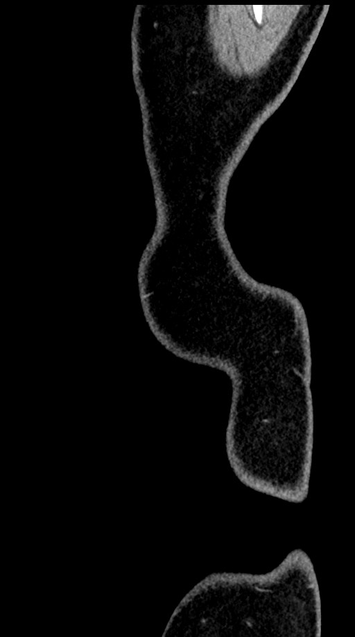 Acute appendicitis (Radiopaedia 77016-88960 Sagittal C+ portal venous phase 1).jpg