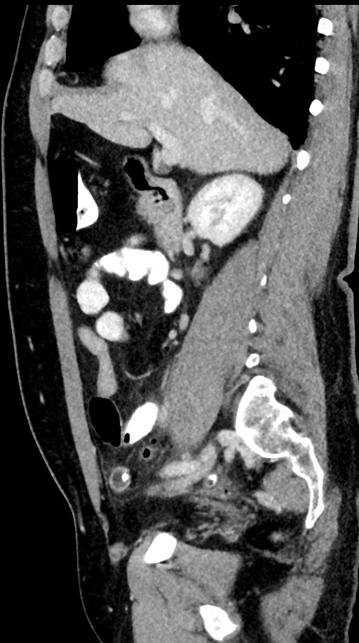 Acute appendicitis (Radiopaedia 77016-88960 Sagittal C+ portal venous phase 72).jpg