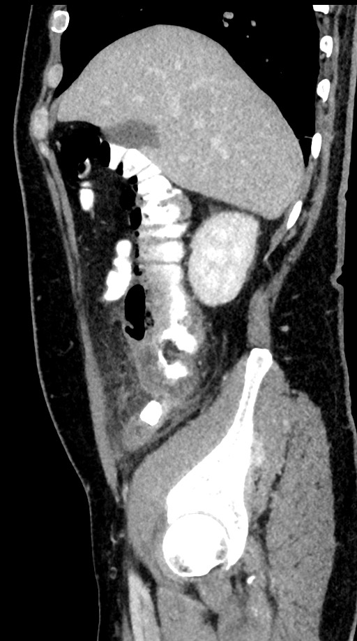 Acute appendicitis (Radiopaedia 77016-88960 Sagittal C+ portal venous phase 86).jpg