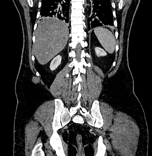 File:Acute appendicitis (Radiopaedia 79950-93224 Coronal C+ portal venous phase 73).jpg