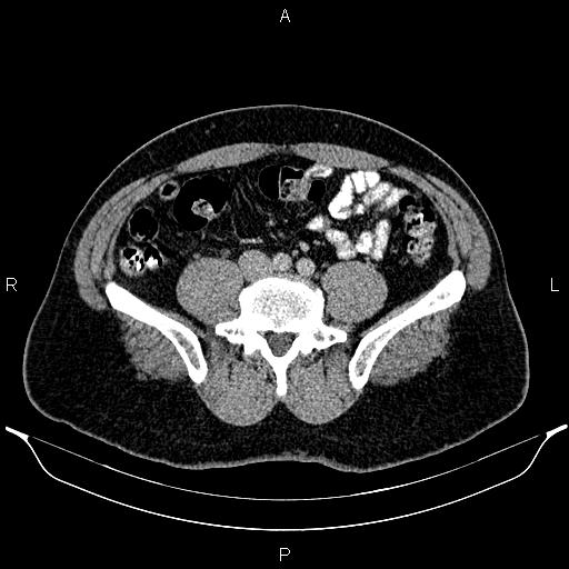 Acute appendicitis (Radiopaedia 84780-100240 Axial C+ portal venous phase 72).jpg