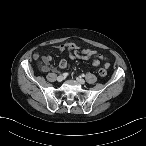 File:Acute appendicitis - large appendicoliths (Radiopaedia 61805-69820 Axial C+ portal venous phase 93).jpg