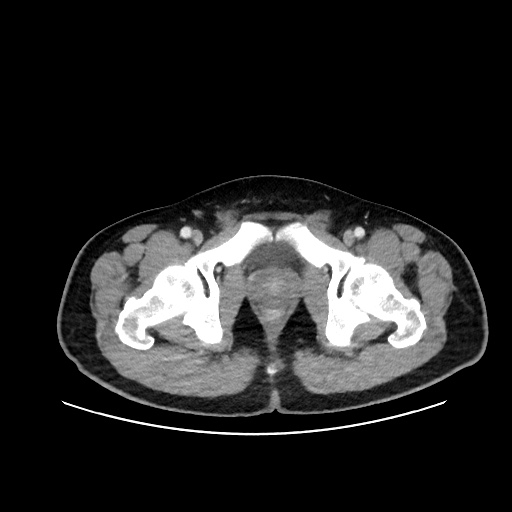 Acute appendicitis and COVID 19 pneumonia (Radiopaedia 76604-88380 Axial C+ portal venous phase 84).jpg