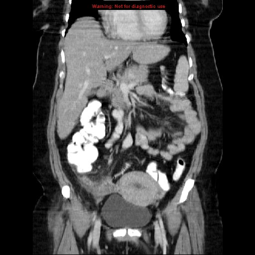 Acute appendicitis complicated by ovarian vein thrombophlebitis (Radiopaedia 16172-15851 Coronal C+ portal venous phase 34).jpg