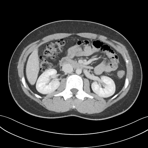 File:Acute appendicitis with appendicoliths (Radiopaedia 50186-55532 Axial C+ portal venous phase 33).png