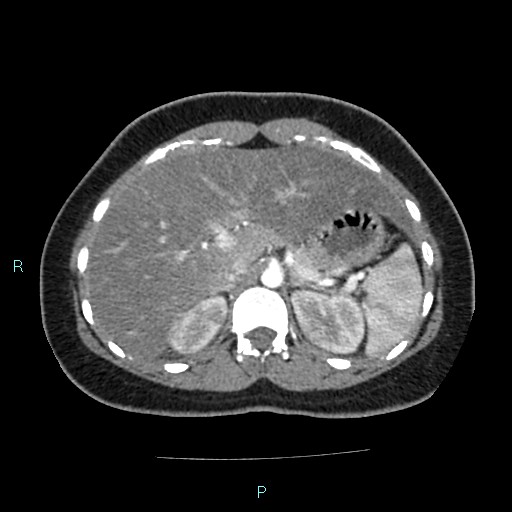 Acute bilateral pyelonephritis (Radiopaedia 37146-38881 Axial C+ arterial phase 47).jpg