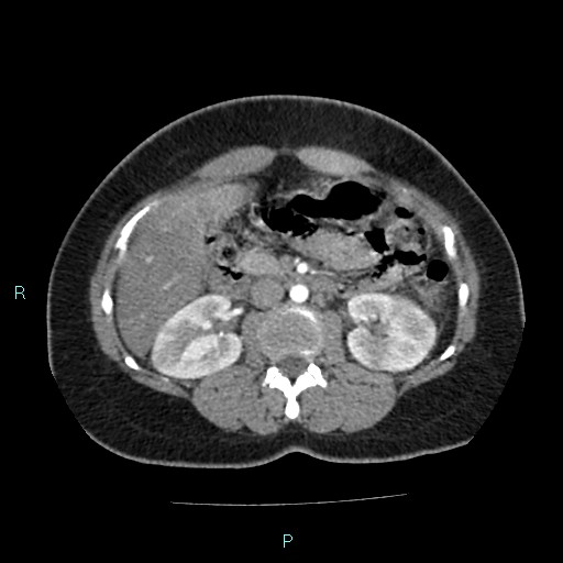 Acute bilateral pyelonephritis (Radiopaedia 37146-38881 Axial C+ arterial phase 81).jpg