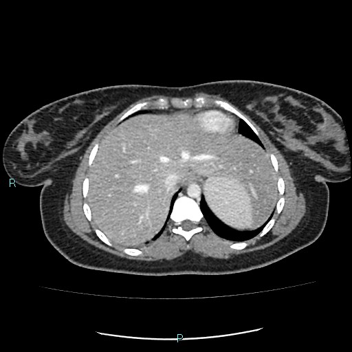 Acute bilateral pyelonephritis (Radiopaedia 37146-38881 Axial C+ portal venous phase 9).jpg