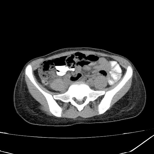 Acute bilateral pyelonephritis (Radiopaedia 74153-84969 Axial non-contrast 35).jpg