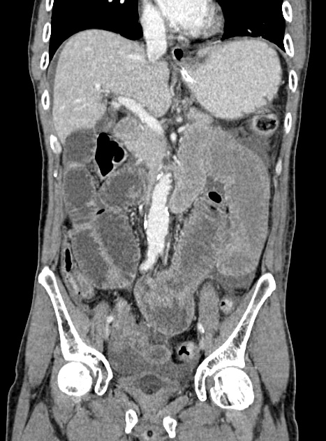 Acute bowel ischemia (Radiopaedia 87695-104114 Coronal C+ portal venous phase 192).jpg