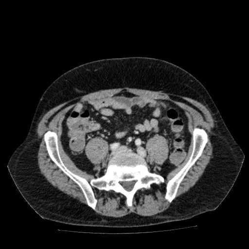 Acute cholecystitis and incidental left sided IVC (Radiopaedia 49352-54459 Axial C+ portal venous phase 107).jpg