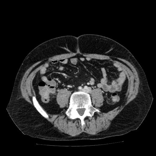 Acute cholecystitis and incidental left sided IVC (Radiopaedia 49352-54459 Axial C+ portal venous phase 97).jpg