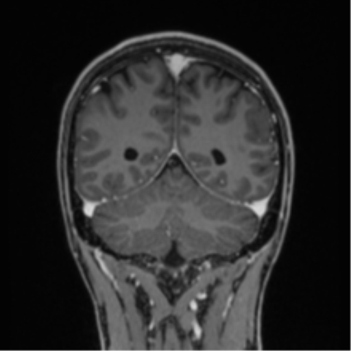 Acute disseminated encephalomyelitis (ADEM) (Radiopaedia 65319-74349 Coronal T1 C+ 3).png
