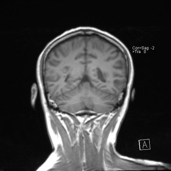 File:Acute disseminated encephalomyelitis (Radiopaedia 37253-39033 Coronal T1 19).jpg
