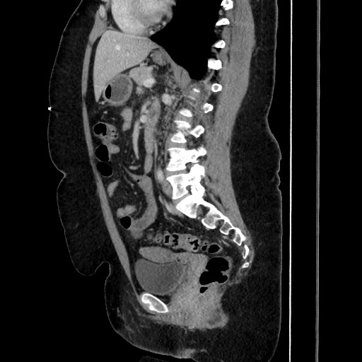 Acute diverticulitis - transverse colon (Radiopaedia 87063-103327 Sagittal C+ portal venous phase 131).jpg