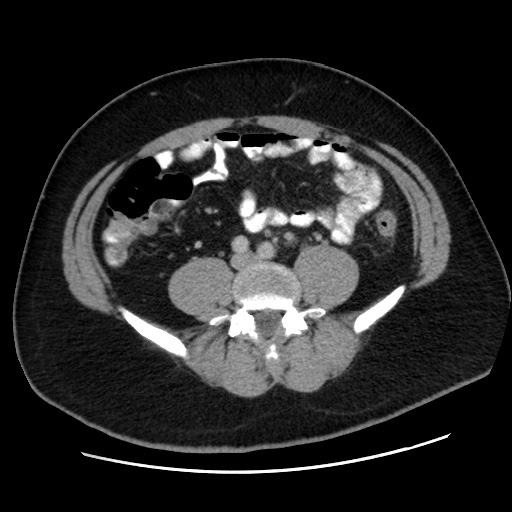 Acute diverticulitis with localized perforation (Radiopaedia 41296-44113 Axial C+ portal venous phase 58).jpg