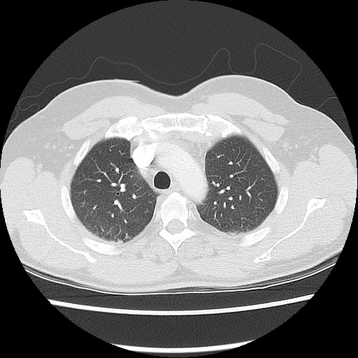Acute epicardial fat necrosis (Radiopaedia 42327-45440 Axial lung window 19).jpg