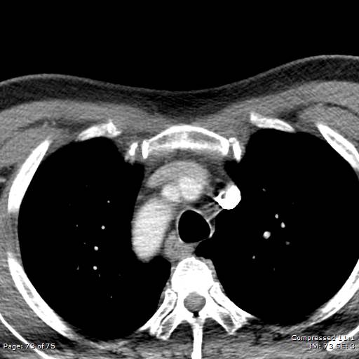 File:Acute epiglottitis (Radiopaedia 54375-60590 Axial C+ arterial phase 73).jpg