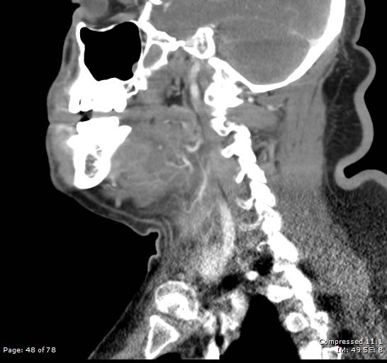 Acute epiglottitis (Radiopaedia 54375-60590 Sagittal C+ arterial phase 48).jpg