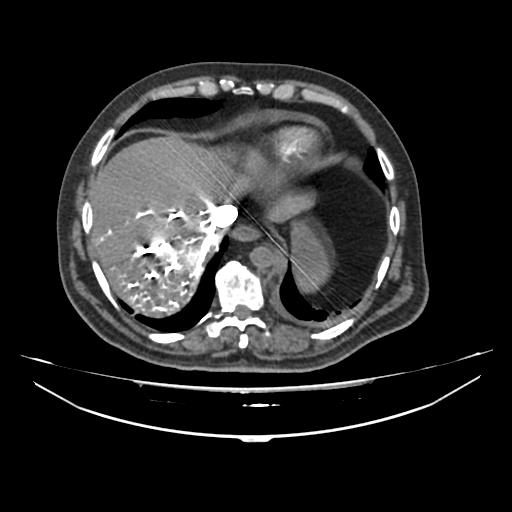 Acute heart failure (CT) (Radiopaedia 79835-93075 Axial C+ arterial phase 61).jpg