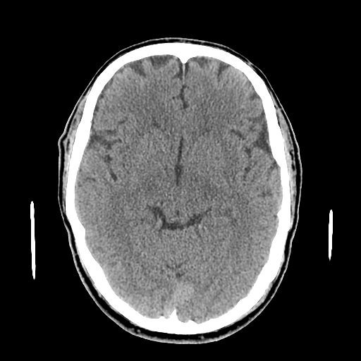 File:Acute hippocampal infarction (Radiopaedia 10610-11071 non-contrast 9).jpg